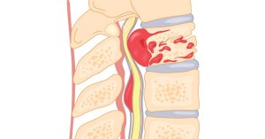 الأسباب الرئيسية وراء التهاب الفقرات العنقية