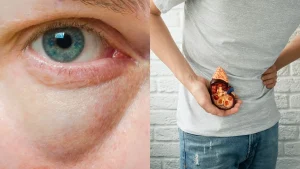 الأسباب المحتملة لإنتفاخ الوجه المرتبط بالكلى