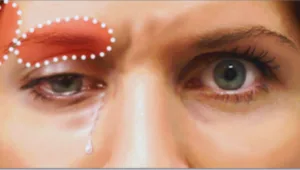 الأعراض الشائعة للكسل البصري