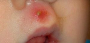 الأعراض المصاحبة للدمامل لدى الأطفال