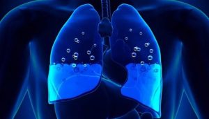 الانصباب الجنبي