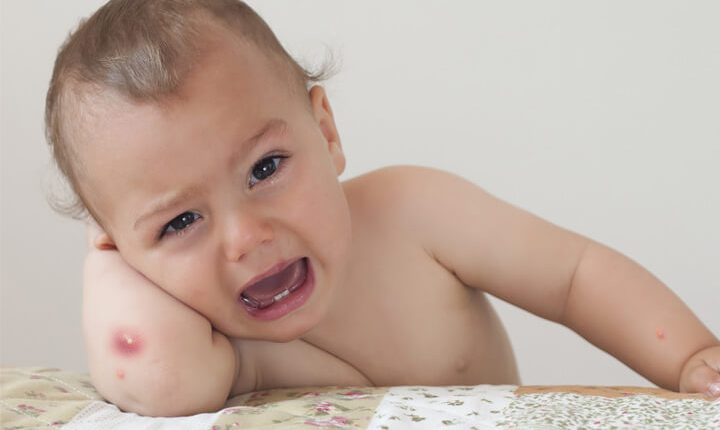 التدابير العلاجية الفعالة للتعامل مع ظهور الدمامل لدى الأطفال