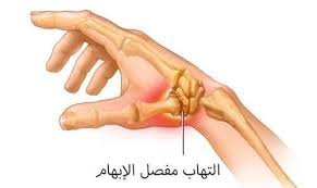 التهاب مفصل الإبهام