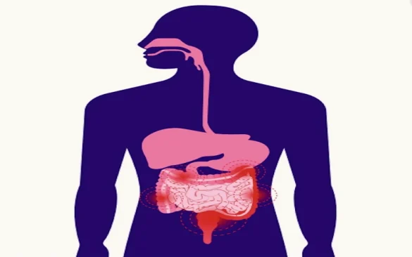 العلامات المرضية الشائعة لالتهاب القولون والمستقيم التقرحي