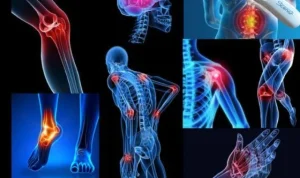 الفيبرومالغيا