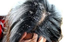 النشاط المفرط للغدد الدهنية في فروة الرأس