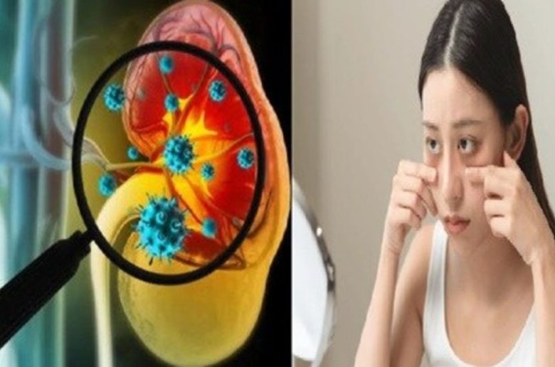 انتفاخ الوجه المرتبط بمرض الكلى