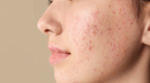 تخفيف مظهر بثور الوجه