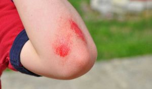 جروح السحجات