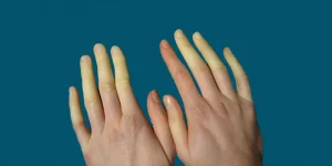 حول متلازمة رينود