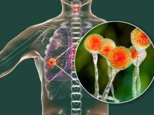 خراجات الرئة