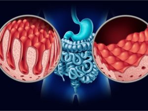 سوء هضم الدهون