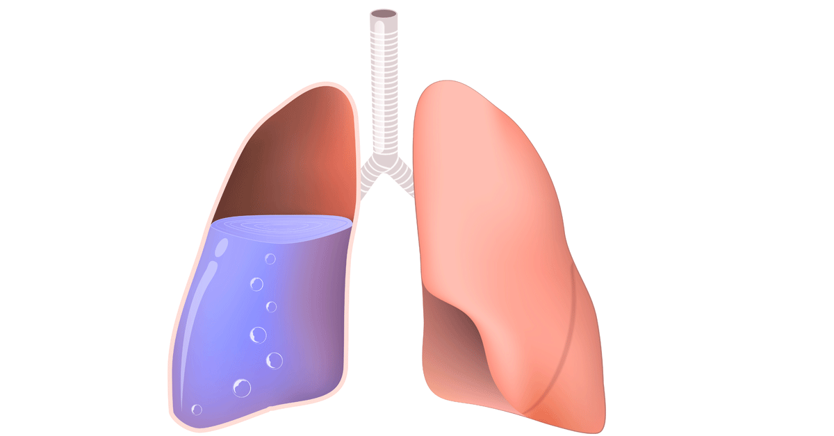 فئات الأشخاص الأكثر عرضة لتجمع الماء على الرئة
