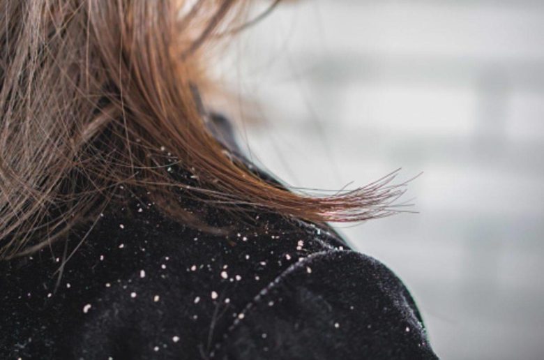 لماذا تزداد قشرة الشعر في فصل الشتاء ؟