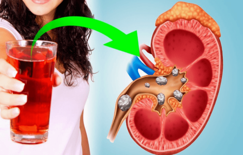 ما هي المشروبات المفيدة للأشخاص المصابين بأمراض الكلى؟