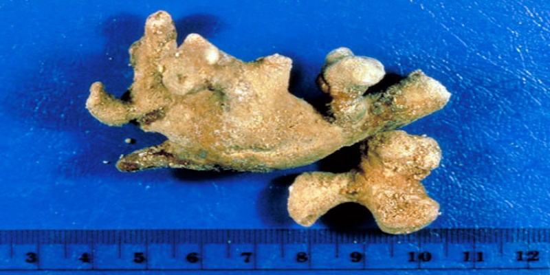 ما هي حصوات الكلى المرجانية؟