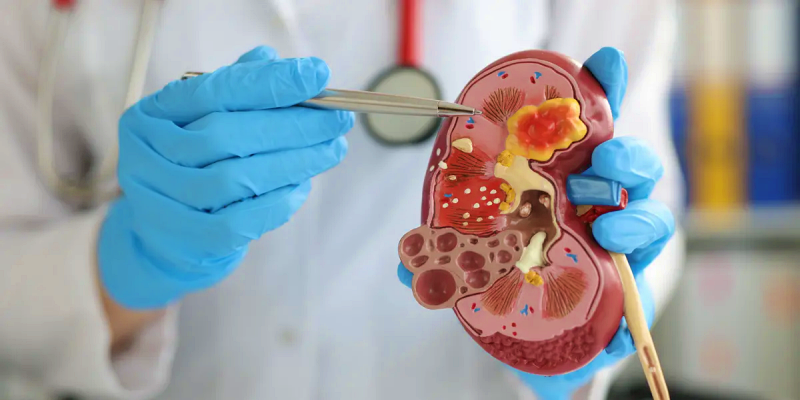 ما هي طرق علاج حصوات الكلى المرجانية؟