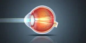 ماالمقصود بالإستجماتيزم ؟