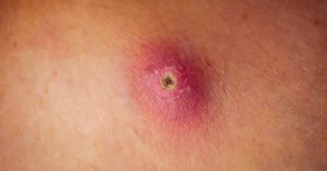 ماالمقصود بالدمل ؟