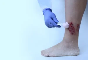 ماهو سبب تأخير التئام الجروح السكرية ؟