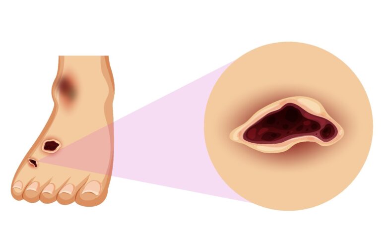 ماهي الخطوات الرئيسية لإلتئام جرح السكري ؟