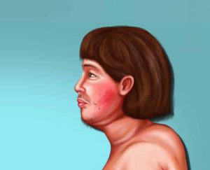 متلازمة كوشينج