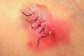 مرحلة الالتهاب