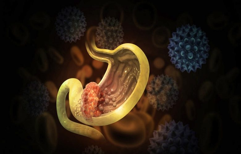4 مضاعفات شائعة لسرطان المعدة يجب أن نكون على دراية بها