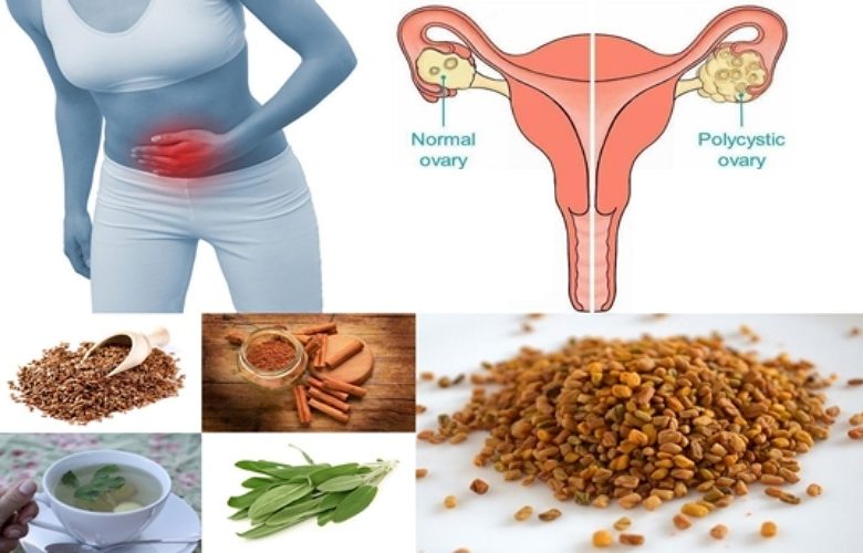 7 توابل هامة للنساء اللواتي يعانين من متلازمة المبايض متعددة الكيسات