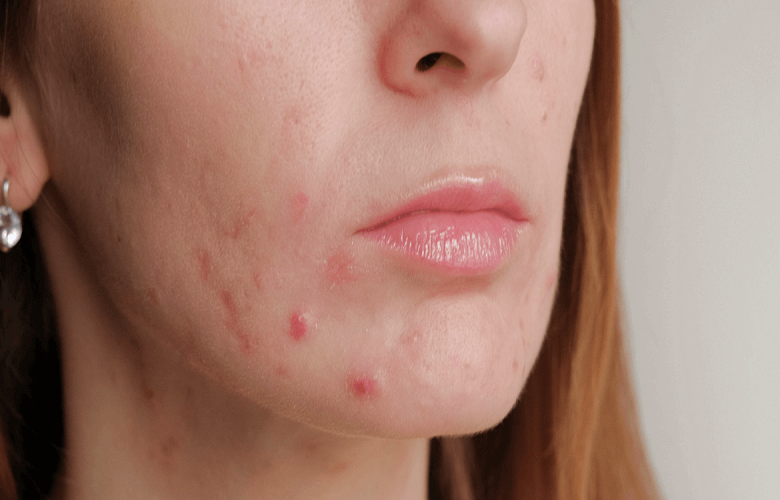 أسباب معاناة النساء في سن اليأس من حب الشباب