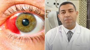 أنواع التجمعات الدموية في العين