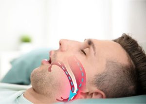 اعتياد التنفس عن طريق الفم أثناء النوم