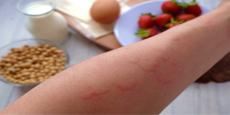 الأسباب الشائعة لحدوث الشرى الجلدي