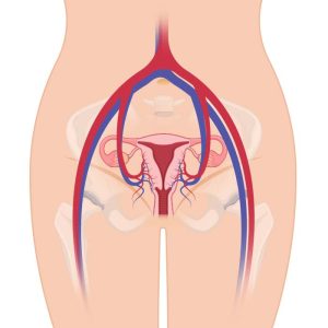 الأسباب الشائعة لدوالي الرحم