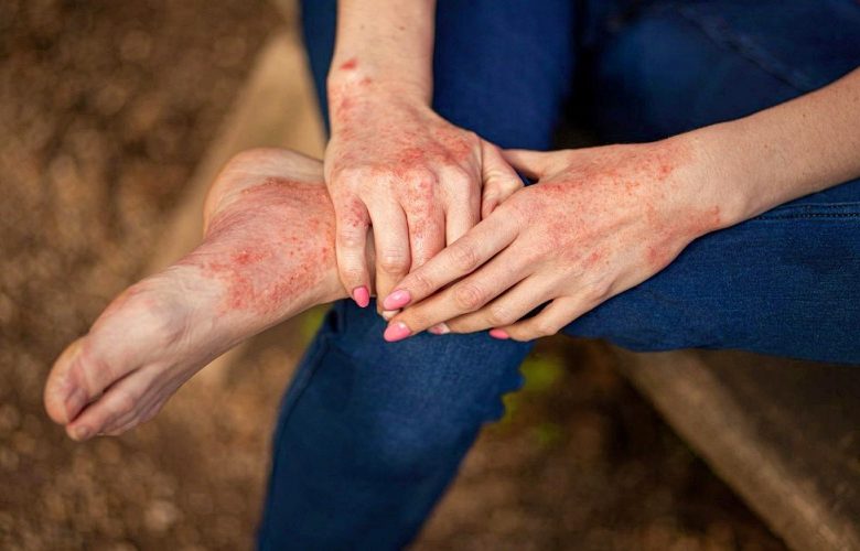 الأسباب الشائعة للشرى الجلدي المسبب للحكة والانزعاج