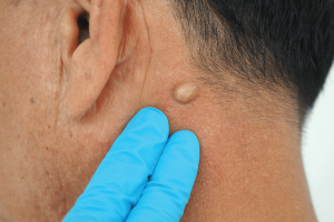 الأكياس الدهنية خلف الأذن