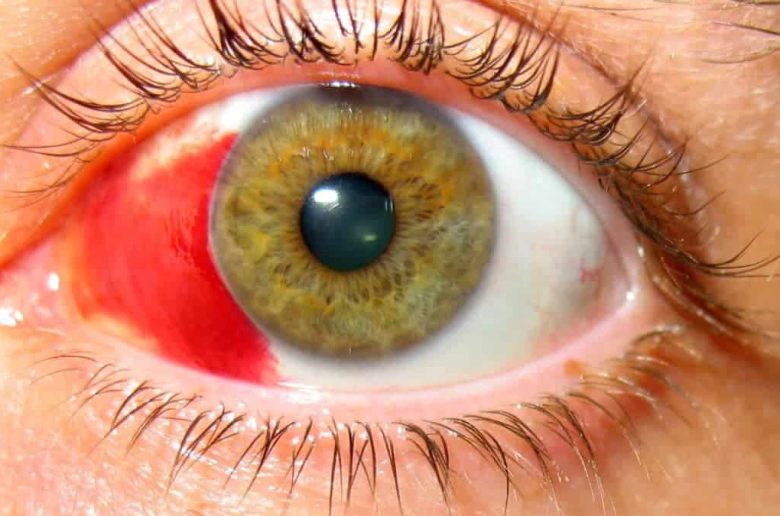 التجمعات الدموية في العين
