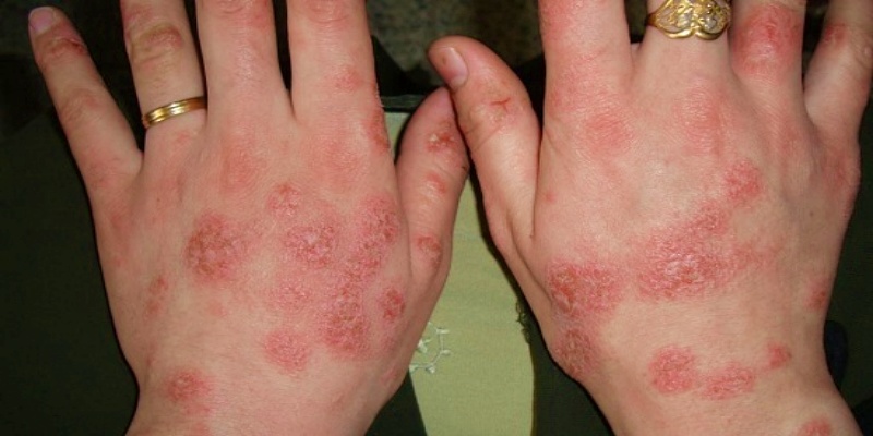 التهاب الجلد التأتبي