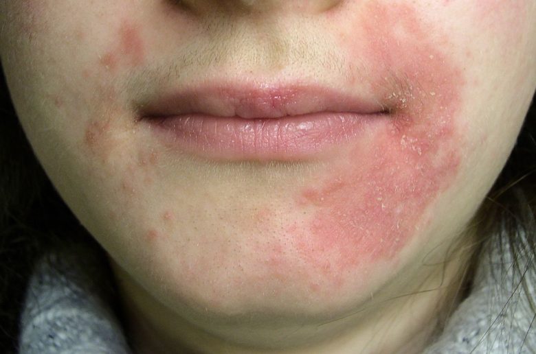 التهاب الجلد حول الفم