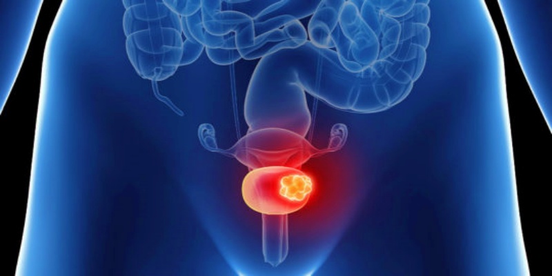 التهاب المثانة الحاد