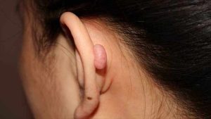 الجدرة الجلدية 