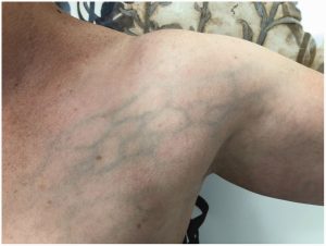 الجلطة الأولية