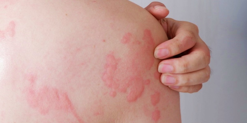 الشرى الجلدي