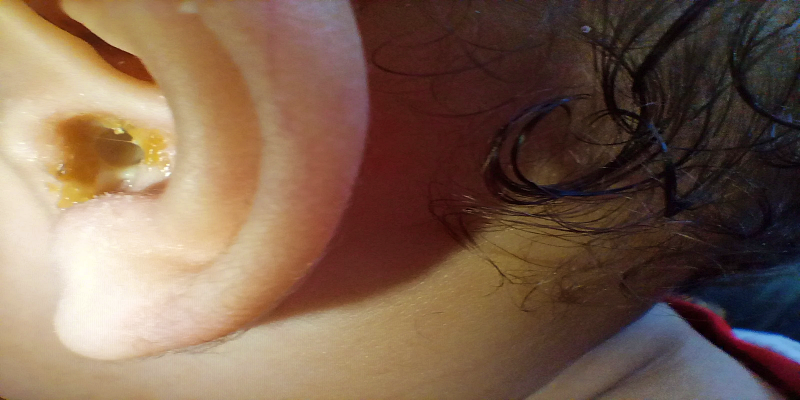 المظاهر السريرية لالتهاب الأذن الوسطى