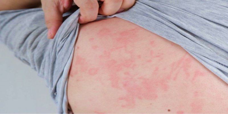 المظاهر الشائعة للشرى الجلدي