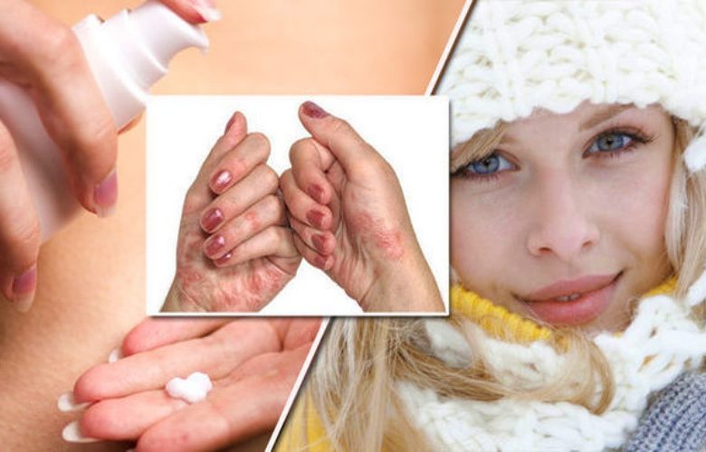 المعاناة من التهاب الجلد التأتبي خلال فصل الشتاء