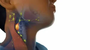 تضخم الغدد اللمفاوية