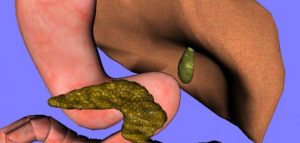 تكلس المرارة