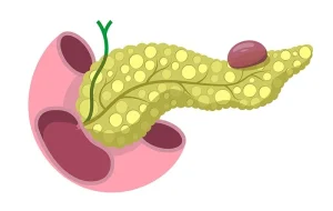 تكيسات البنكرياس