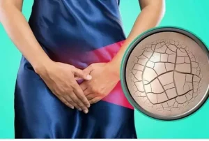 جفاف المهبل